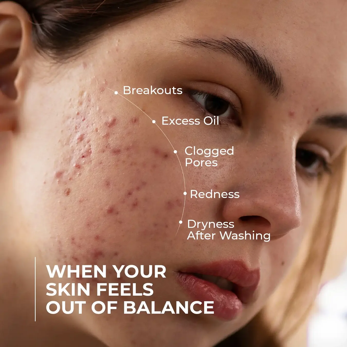 Skin Centrick | Acne Face Wash | Salicylic Acid, Niacinamide & Tea Tree | Oily & Blemish-Prone Skin | 100 ml