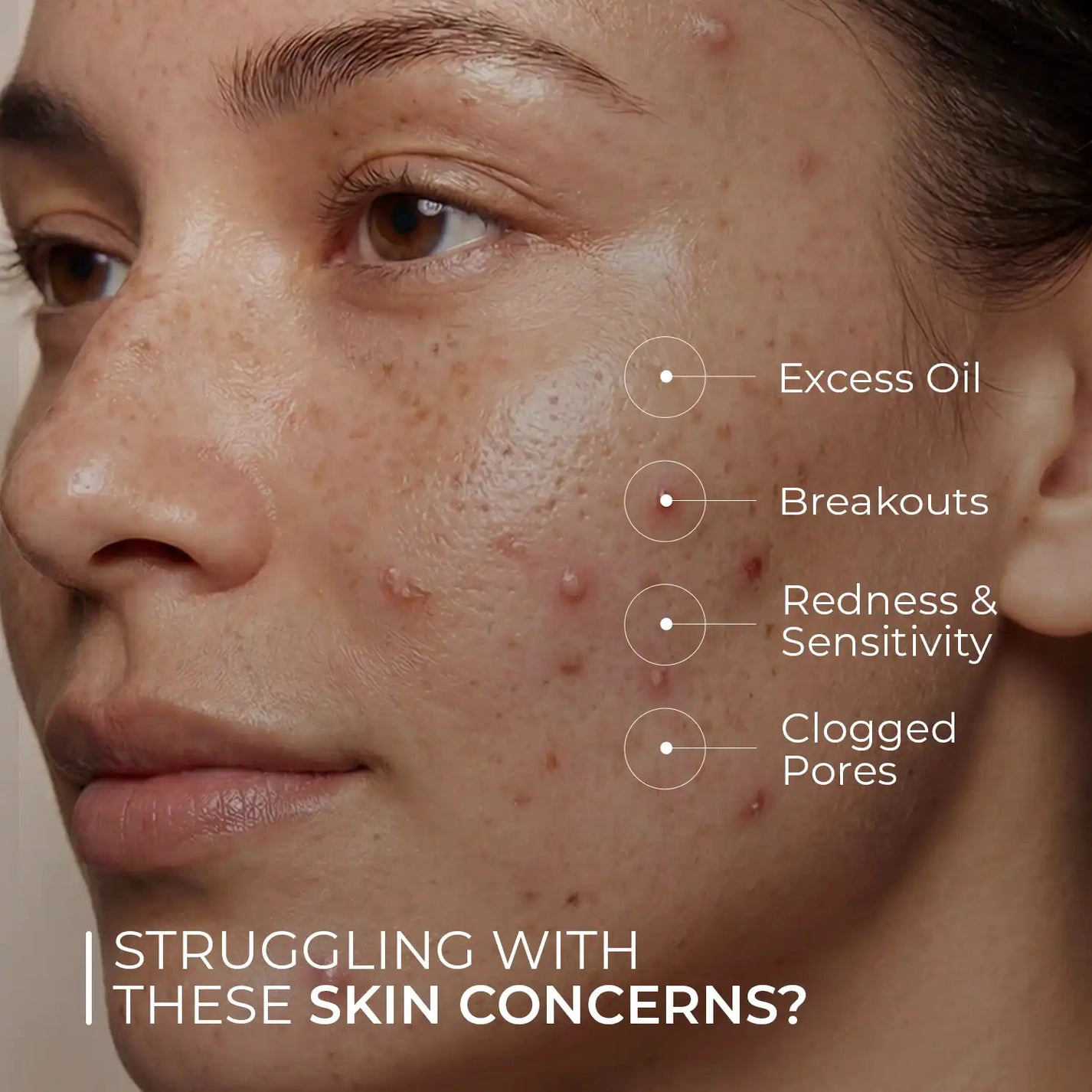 Skin Centrick Acne Night Cream - 1% Salicylic Acid & Tea Tree Oil